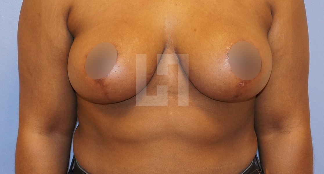 Photo après la reduction mammaire | Dr Hanan | Paris