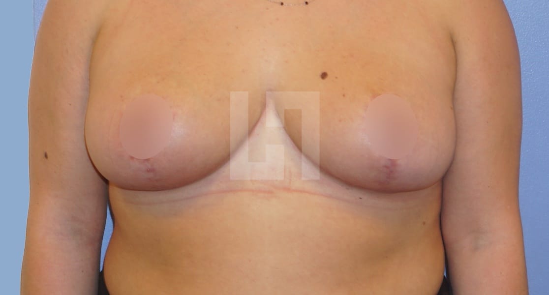 Résultats après une réduction mammaire | Dr Hanan | Paris