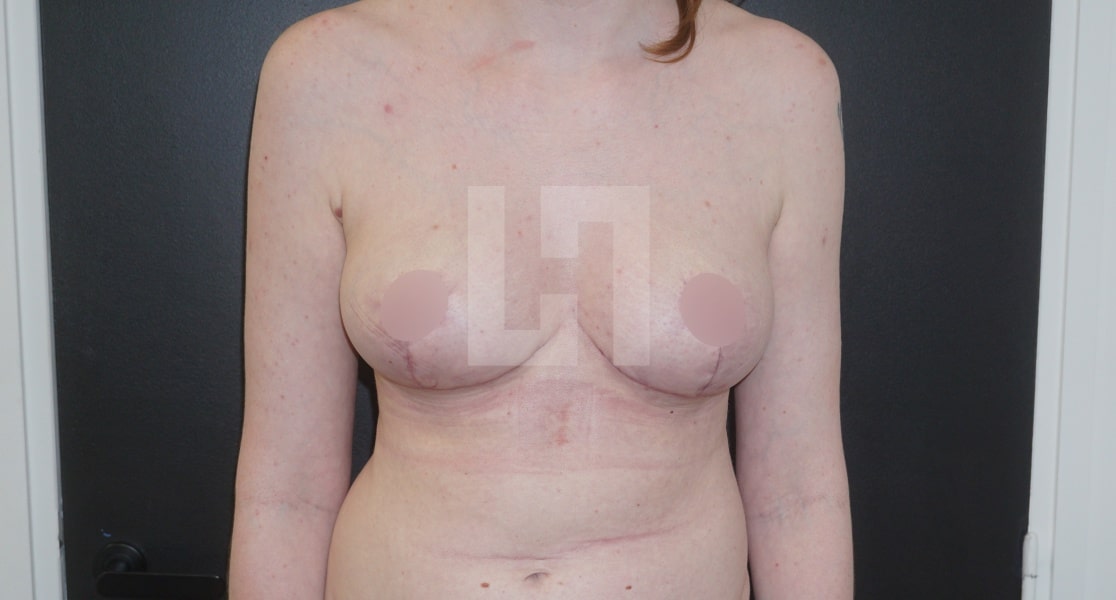Reduction mammaire vu de face | Dr Hanan | Paris
