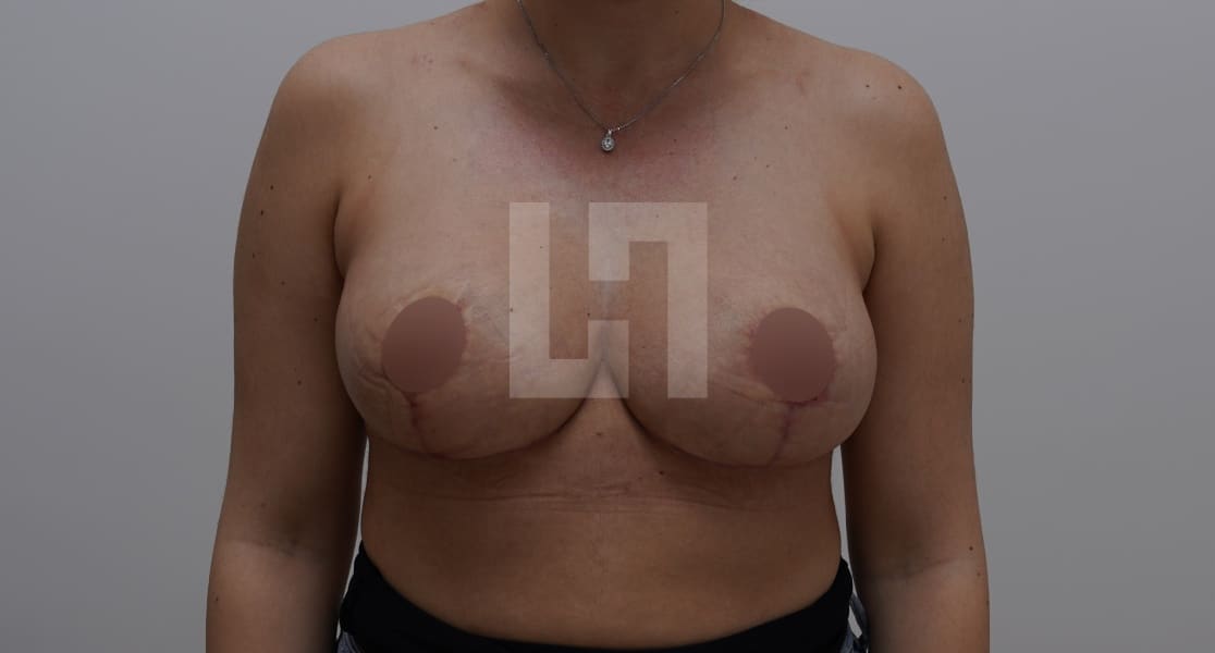 Photo après la chirurgie de réduction mammaire