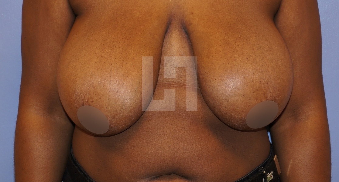 Photo avant la reduction mammaire | Dr Hanan | Paris