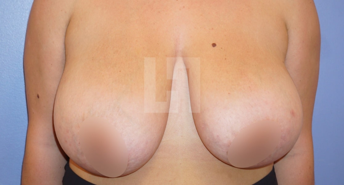 Résultats avant une réduction mammaire | Dr Hanan | Paris