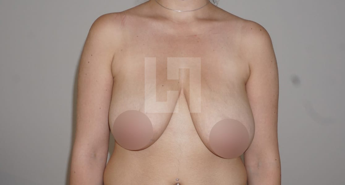 Photo avant la chirurgie de réduction mammaire